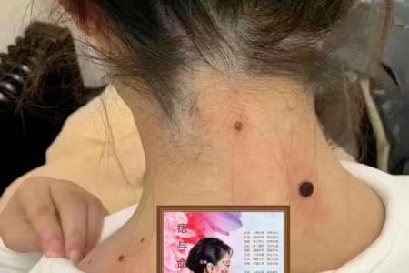 风水上后脑勺长痣代表什么意思