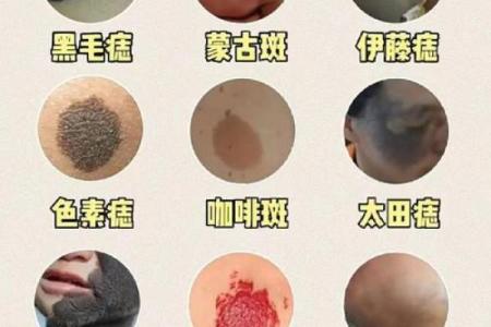 胎记算命图解：什么是红胎记？