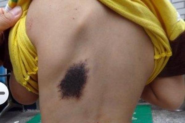 脸上胎记算命看出命运