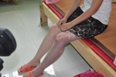 腰部上的胎记如何算命分析？