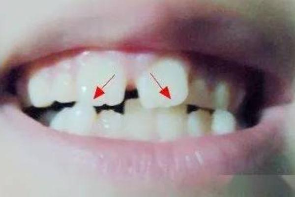 八字牙齿