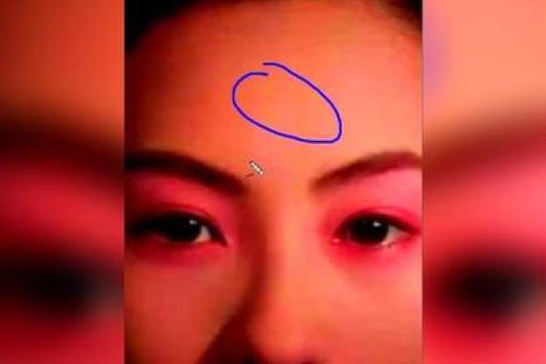 红色胎记算命看危害