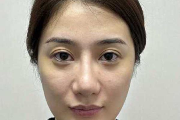 眉心八字纹