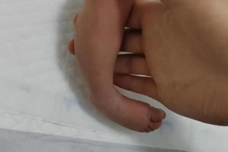儿童内八字脚