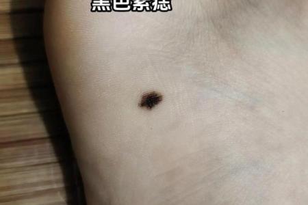脚上胎记算命，脚底长胎记好不好