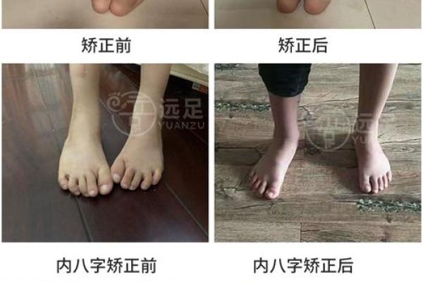 内八字和外八字